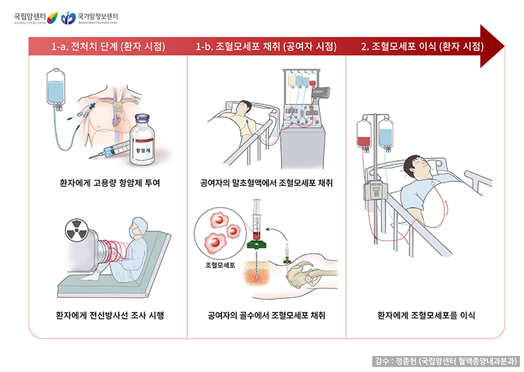 동종조혈모세포이식의 과정
